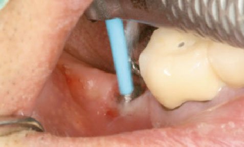 I-Brush-2_imagem3